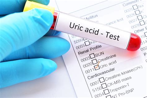 low serum uric acid level.